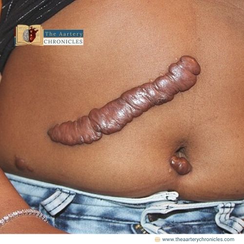 keloids-causes-symptoms-and-effective-treatments-you-need-to-know-the-aartery-chronicles-tac