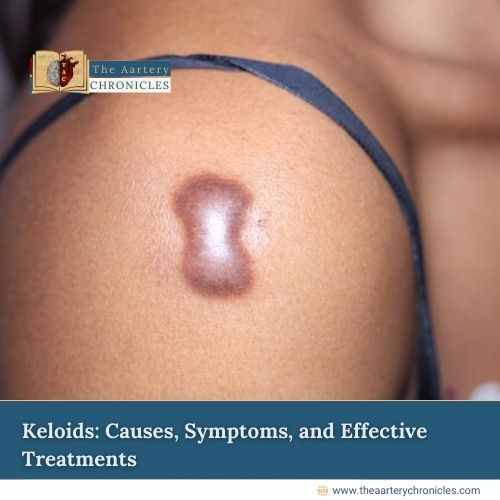 keloids-causes-symptoms-and-effective-treatments-you-need-to-know-the-aartery-chronicles-tac