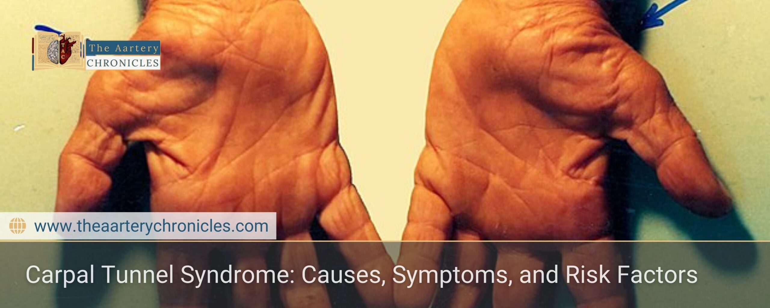 carpal-tunnel-syndrome-everything-that-you-need-to-know-the-aartery-chronicles-tac