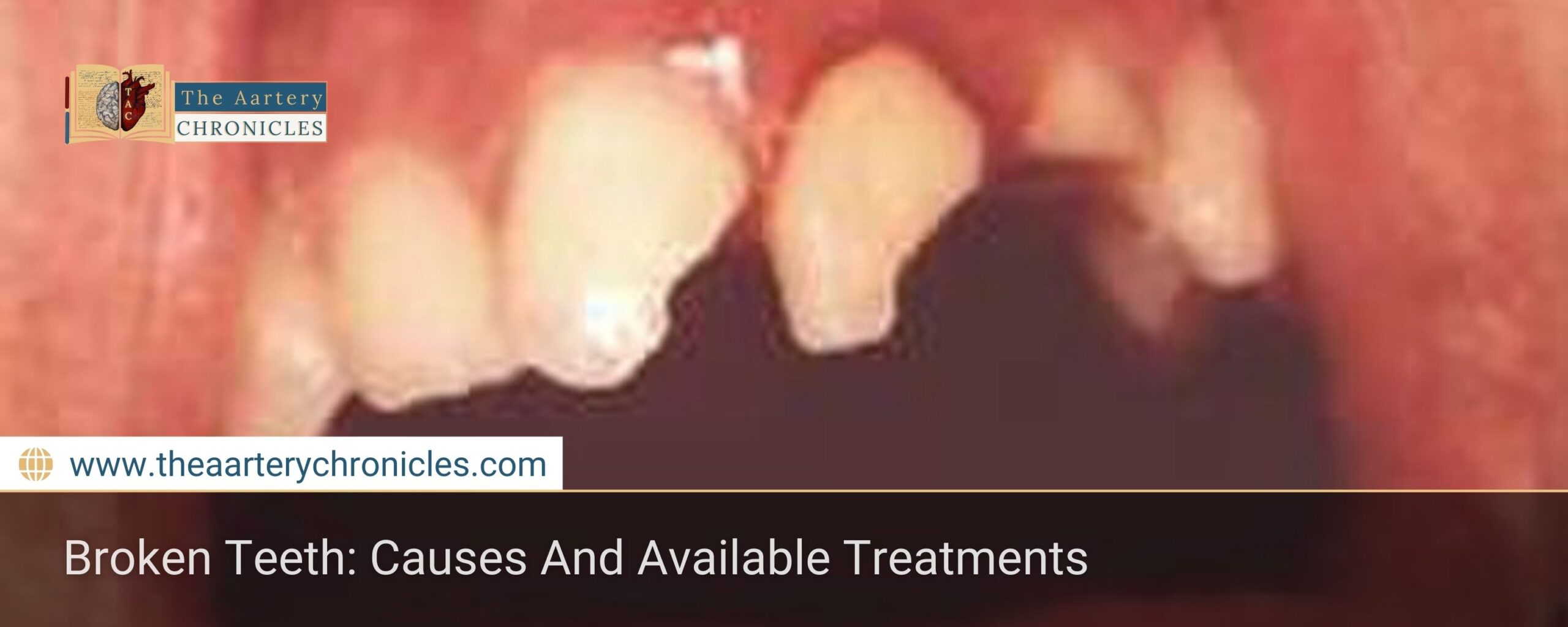 Broken-Teeth:-Causes-And-Available-Treatments-The-Aartery-Chronicles-TAC