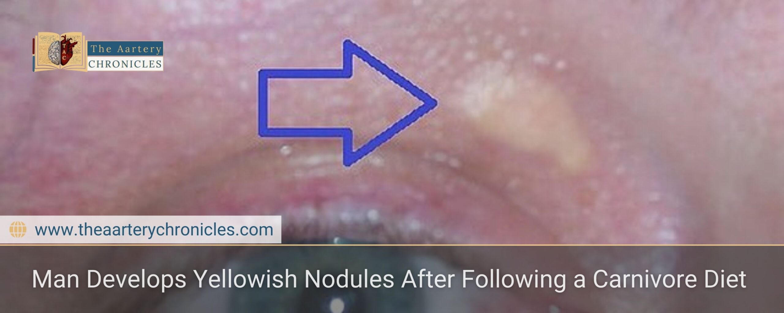 Man Develops Yellowish Nodules After Following a Carnivore Diet