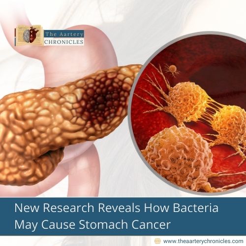 New Research Reveals How Bacteria May Cause Stomach Cancer