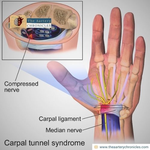 carpal-tunnel-syndrome-everything-that-you-need-to-know-the-aartery-chronicles-tac