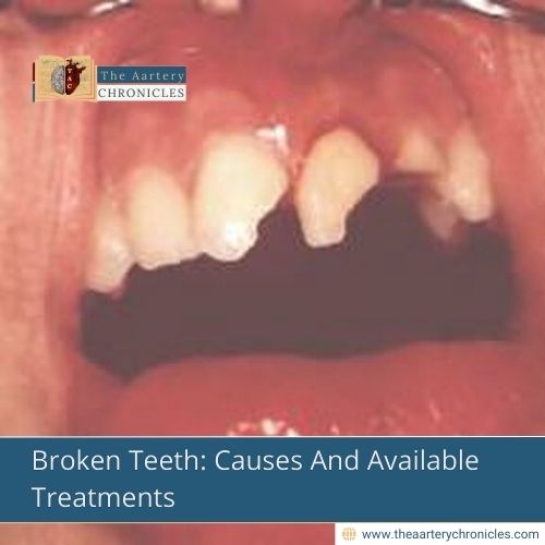 Broken Teeth: Causes And Available Treatments