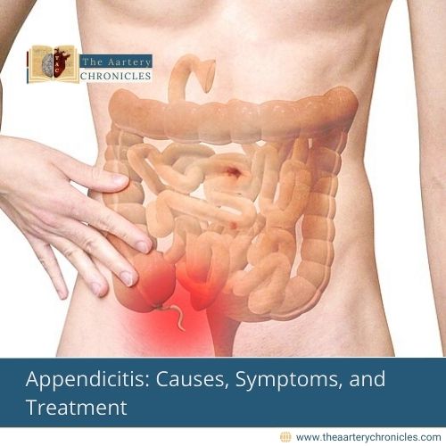 Appendicitis: Causes, Symptoms, Treatment that you need to know