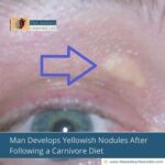 Man Develops Yellowish Nodules After Following a Carnivore Diet