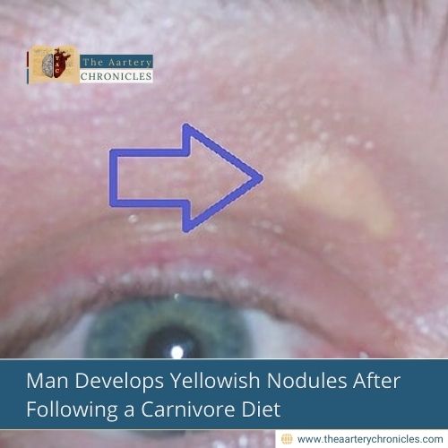 Man Develops Yellowish Nodules After Following a Carnivore Diet