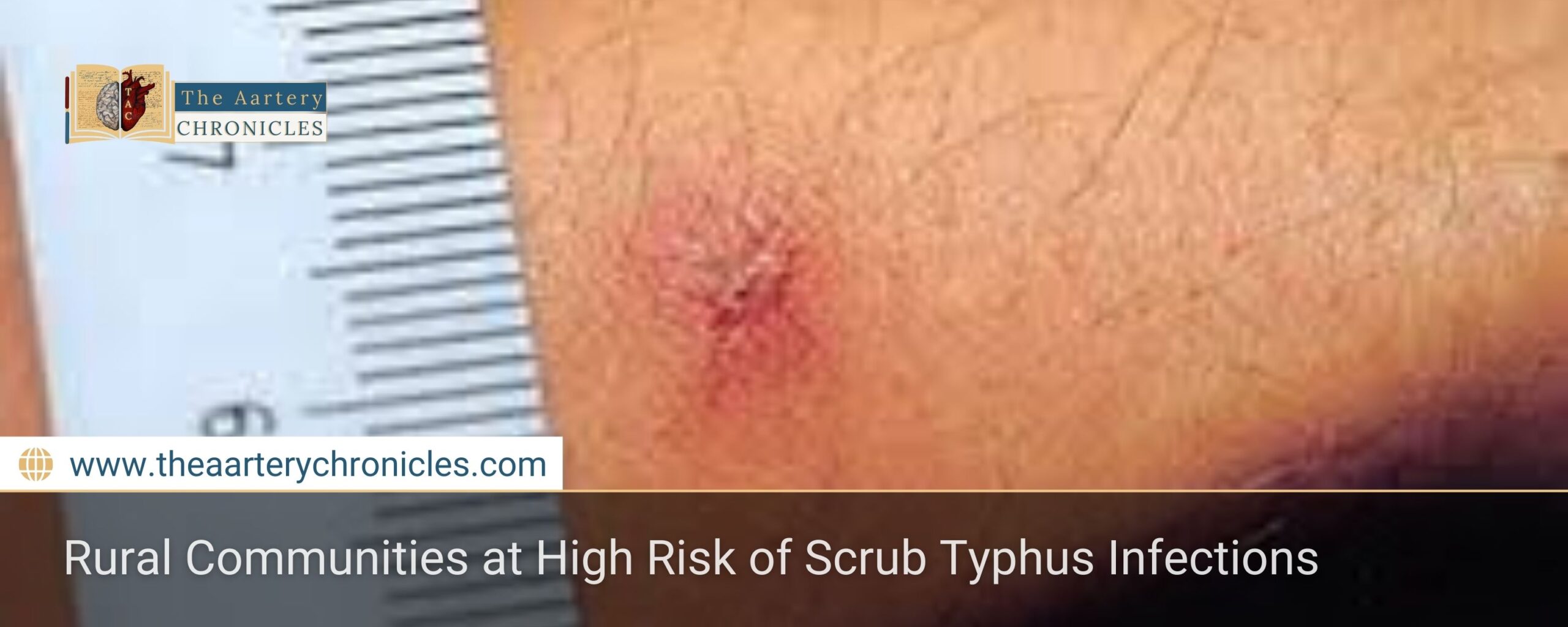 Rural Communities at High Risk of Scrub Typhus Infections