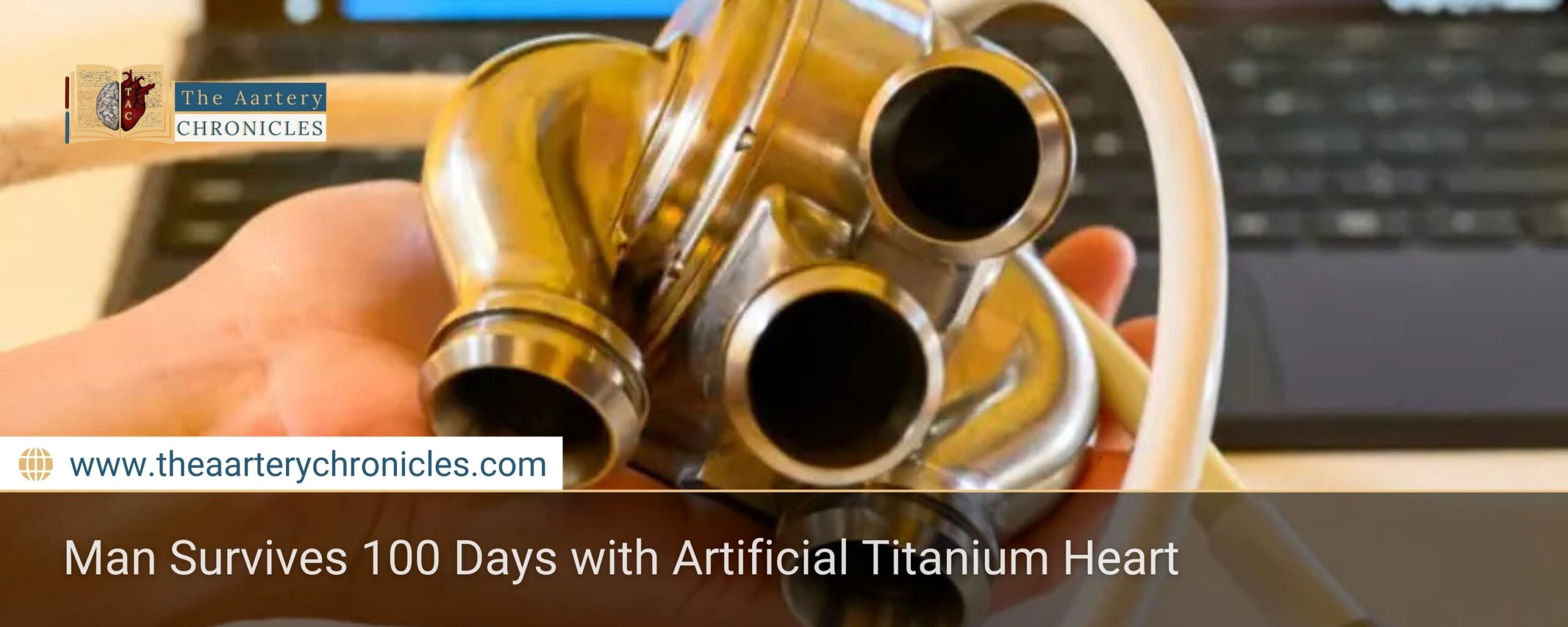 Man Survives 100 Days with Artificial Titanium Heart