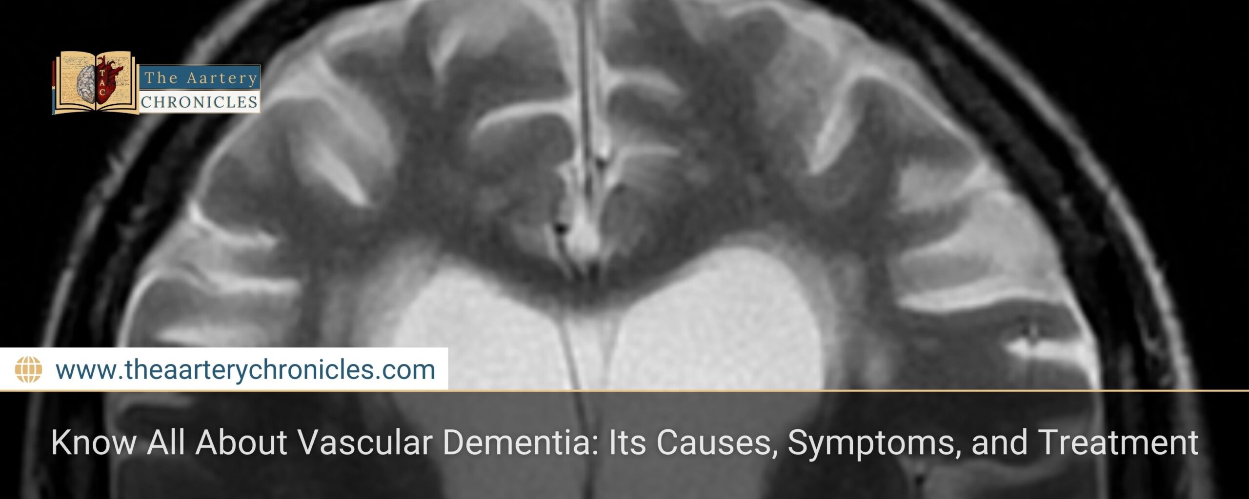 Know-All-About-Vascular-Dementia:-Its-Causes,-Symptoms,-and-Treatment-The-Aartery-Chronicles-TAC