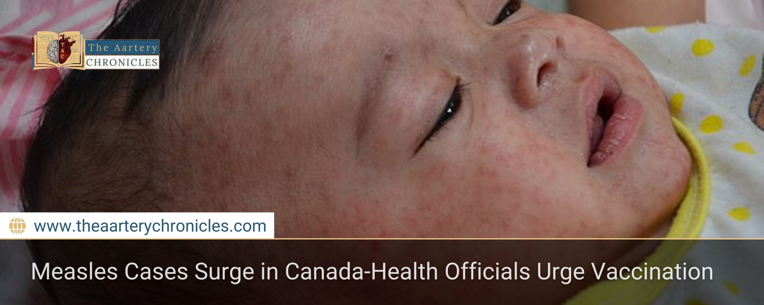 measles-cases-rising-rapidly-in-canada-heres-what-you-need-to-know-the-aartery-chronicles-tac