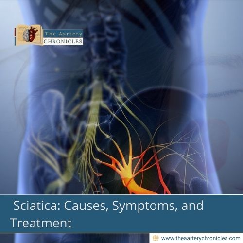 All-About-Sciatica:-Causes,-Symptoms,-and-Treatment-The-Aartery-Chronicles-TAC