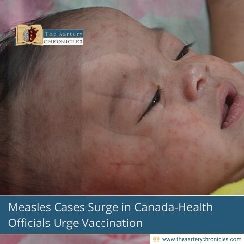 Measles Cases Rising Rapidly in Canada-Here’s What You Need to Know