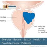 exercise-boosts-sexual-health-in-prostate-cancer-patients-the-aartery-chronicles-tac