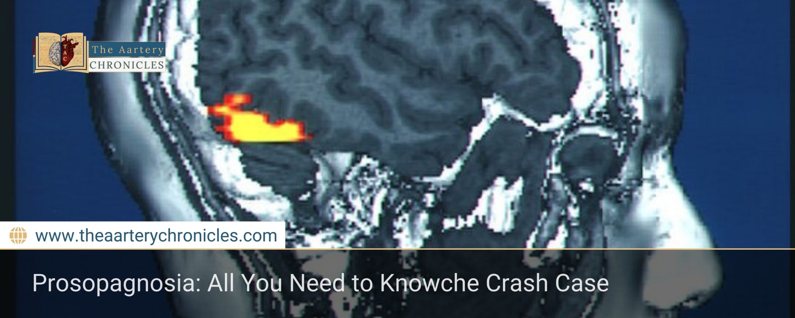 Prosopagnosia:-All-You-Need-to-Know-The-Aartery-Chronicles-TAC