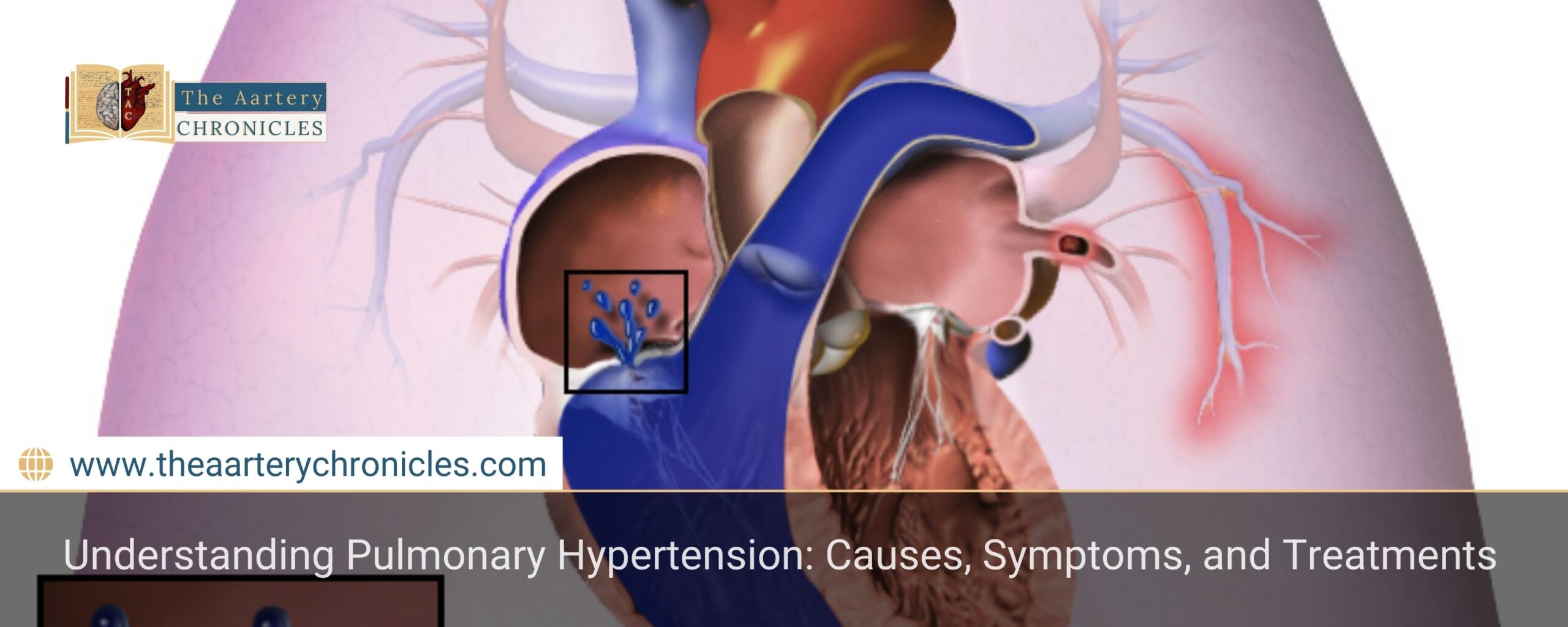 Understanding-Pulmonary-Hypertension: -Causes,-Symptoms,-and-Treatments-The-Aartery-Chronicles-TAC