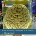 Metal from Implants Found in Brain Fluid—Is It Dangerous?