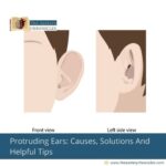 Protruding-Ears:-Causes,-Solutions-And-Helpful-Tips-The-Aartery-Chroicles-TAC