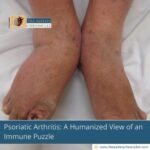 Psoriatic-Arthritis:-A-Humanized-View-of-an-Immune-Puzzle-The-Aartery-Chronicles-TAC
