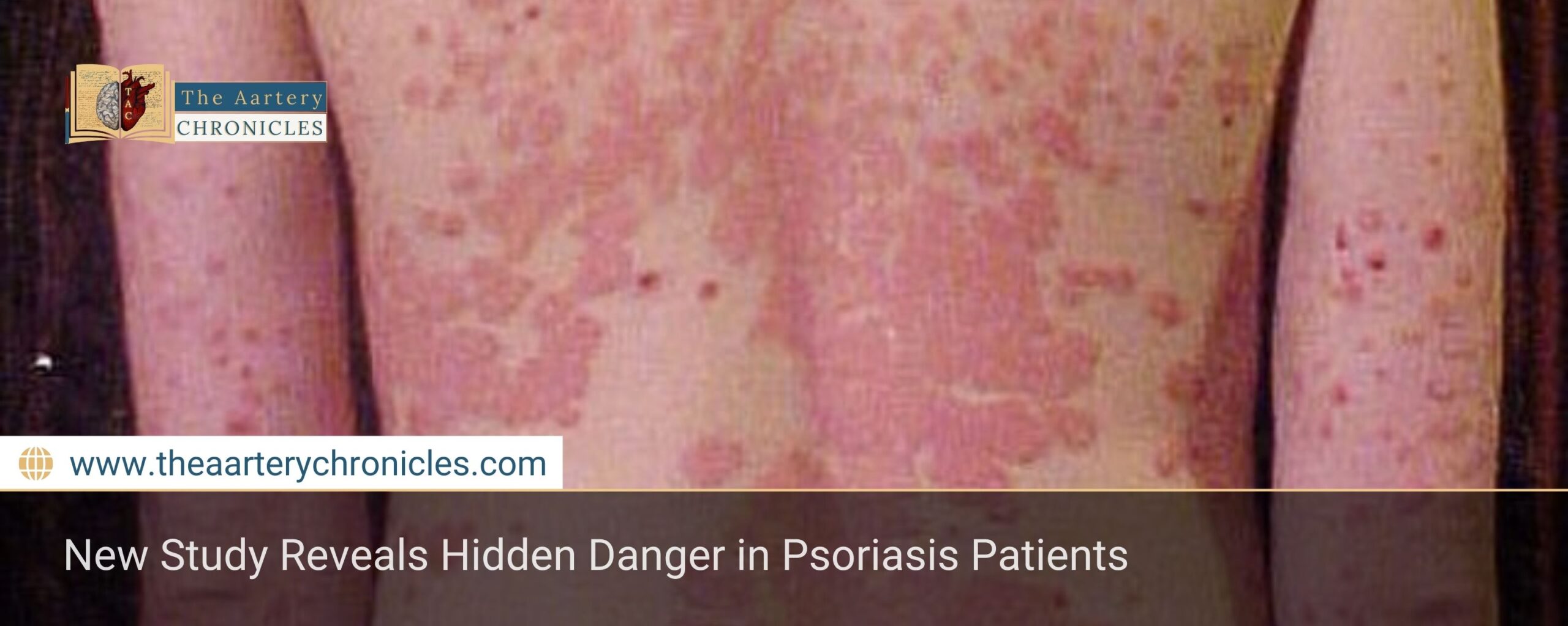 New Study Reveals Hidden Danger in Psoriasis Patients