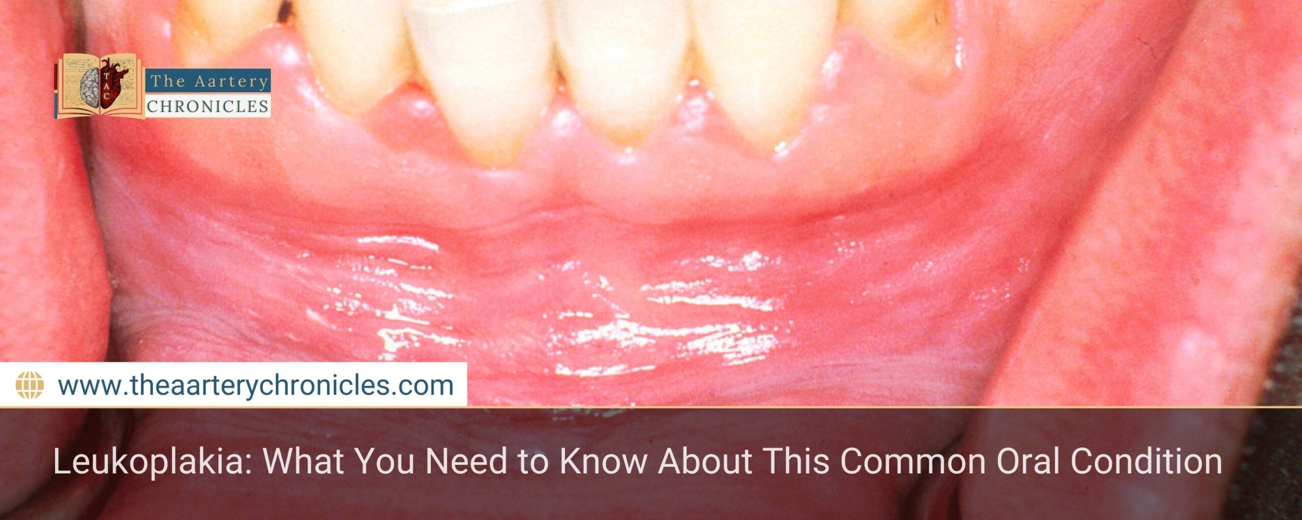 Leukoplakia:-What-You-Need-to-Know-About-This-Common-Oral-Condition-The-Aartery-Chronicles-TAC