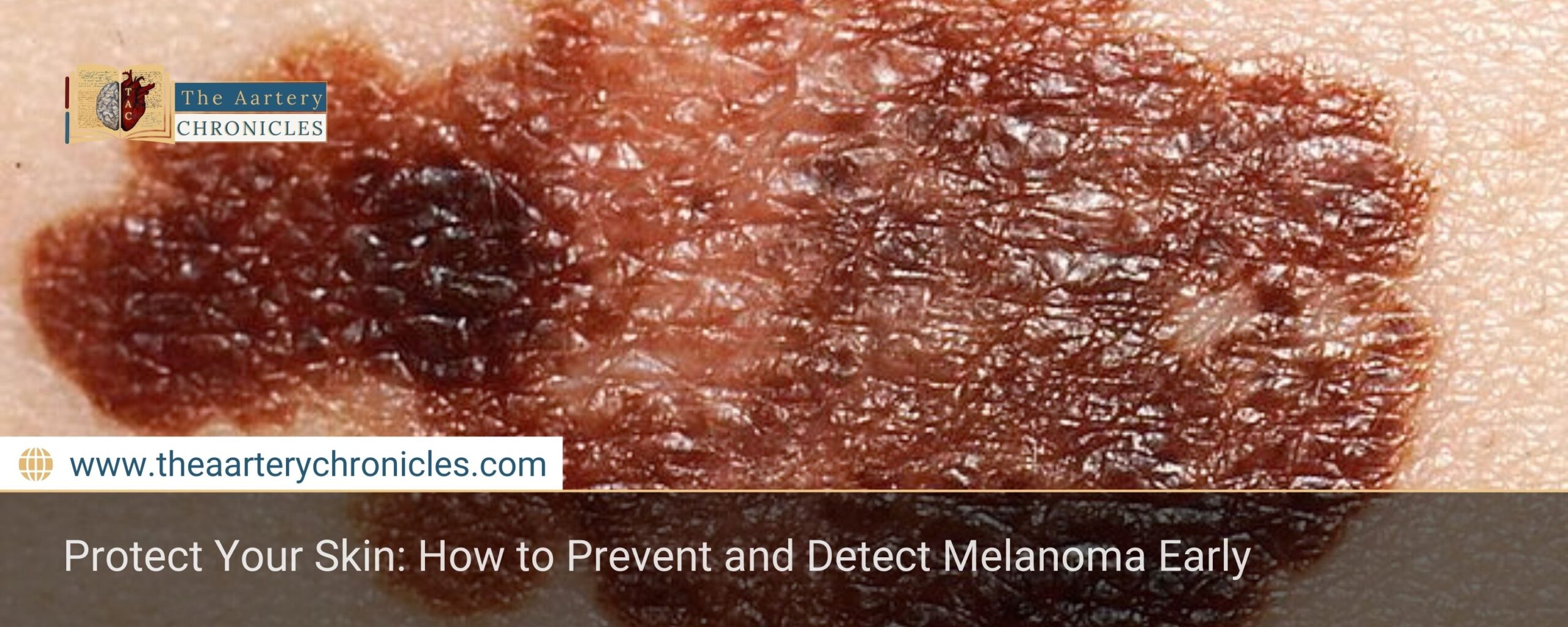 Protect-Your-Skin:-How-to-Prevent-and-Detect-Melanoma-Early-The-Aartery-Chronicles-TAC