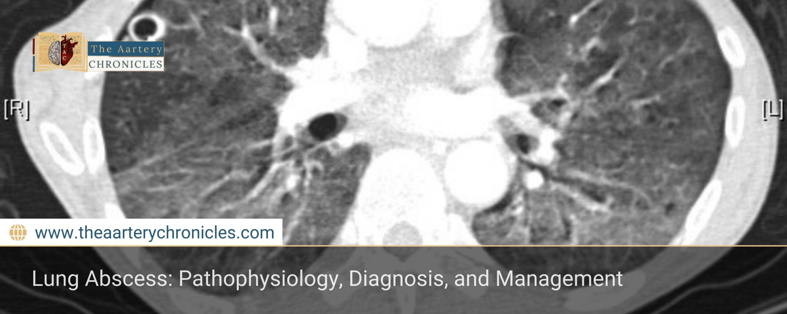 Lung-Abscess:-Pathophysiology,-Diagnosis,-and-Management-The-Aartery-Chronicles-TAC