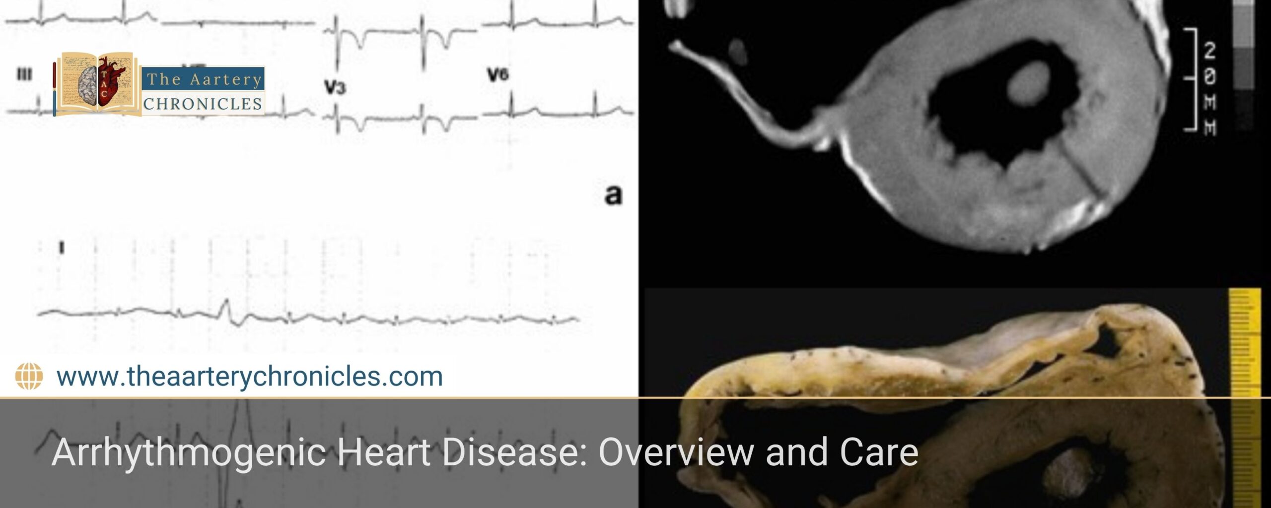 Arrhythmogenic-Heart-Disease:-Overview-and-Care-The-Aartery-Chronicles-TAC