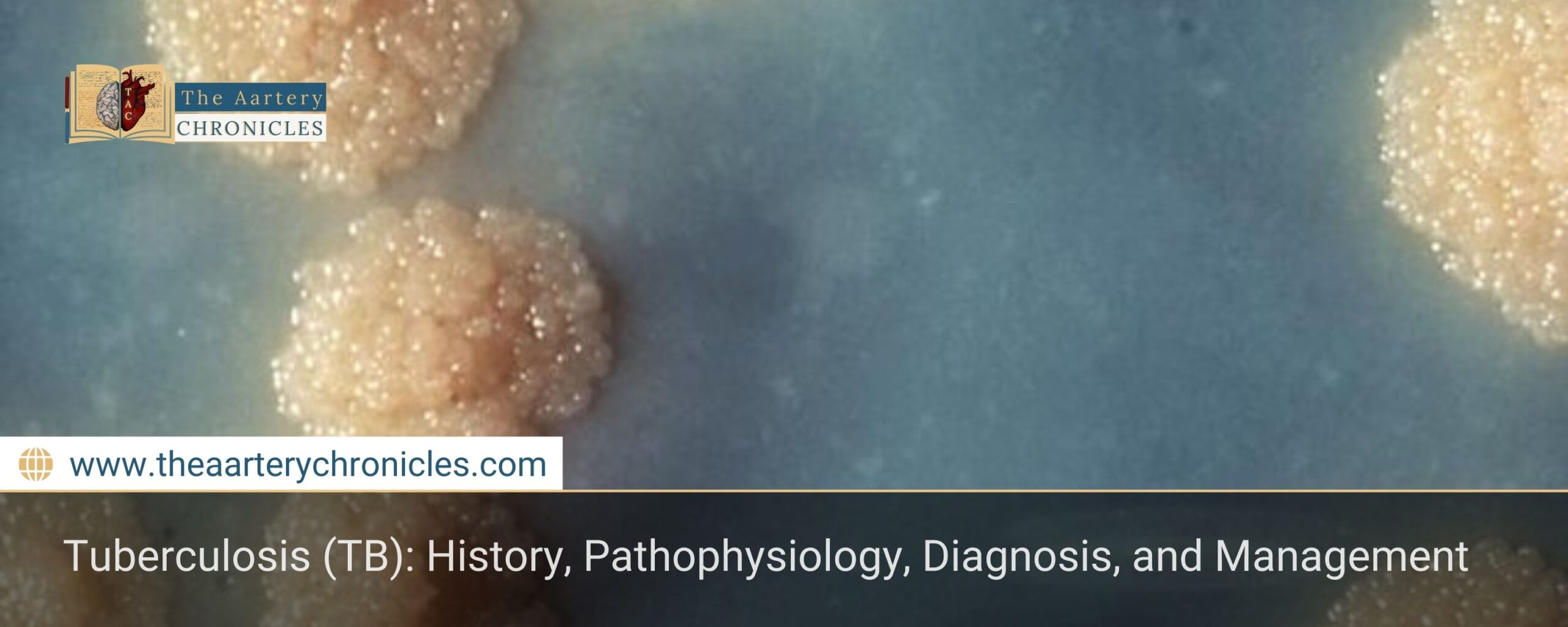 Tuberculosis-(TB):-History,-Pathophysiology,-Diagnosis,-and-Management-The-Aartery-Chronicles-TAC