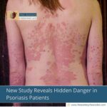 New Study Reveals Hidden Danger in Psoriasis Patients