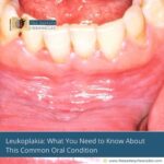 Leukoplakia:-What-You-Need-to-Know-About-This-Common-Oral-Condition-The-Aartery-Chronicles-TAC