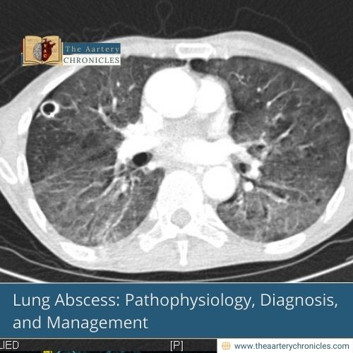 Lung Abscess: Pathophysiology, Diagnosis, and Management