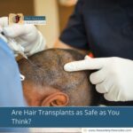 Are Hair Transplants as Safe as You Think?