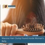 Massive Hair Clump Found Inside Woman’s Belly