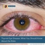 Thyroid-Eye-Disease-What-You-Should-Know-About-the-Risks-The-Aartery-Chronicles-TAC