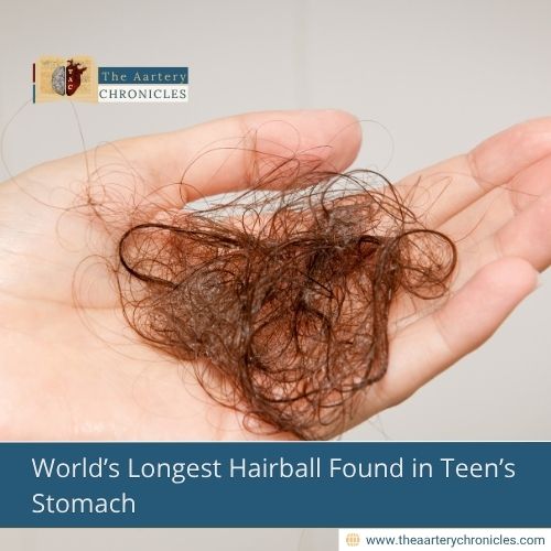 World’s Longest Hairball Found in Teen’s Stomach
