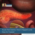 Acute-Pancreatitis:-How-It-Happens-and-How-It’s-Treated-The-Aartery-Chronicles-TAC