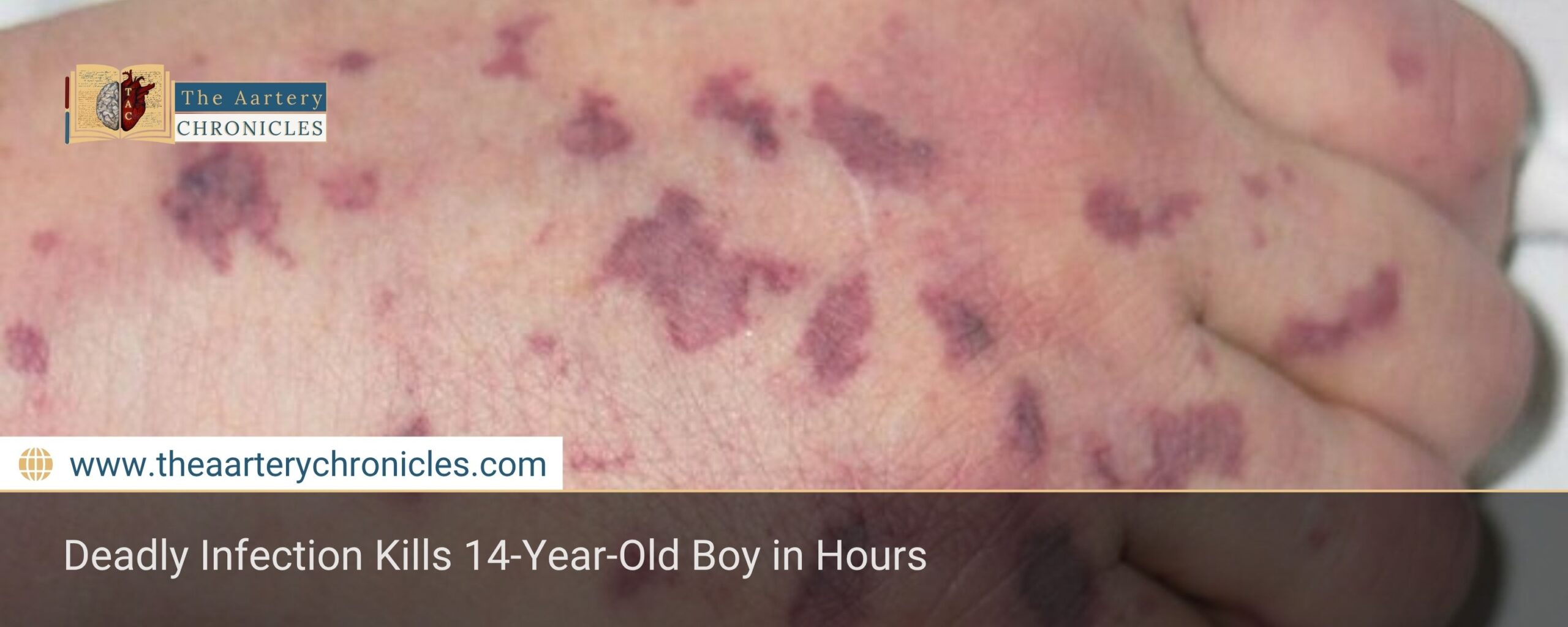 Deadly Infection Kills 14-Year-Old Boy in Hours