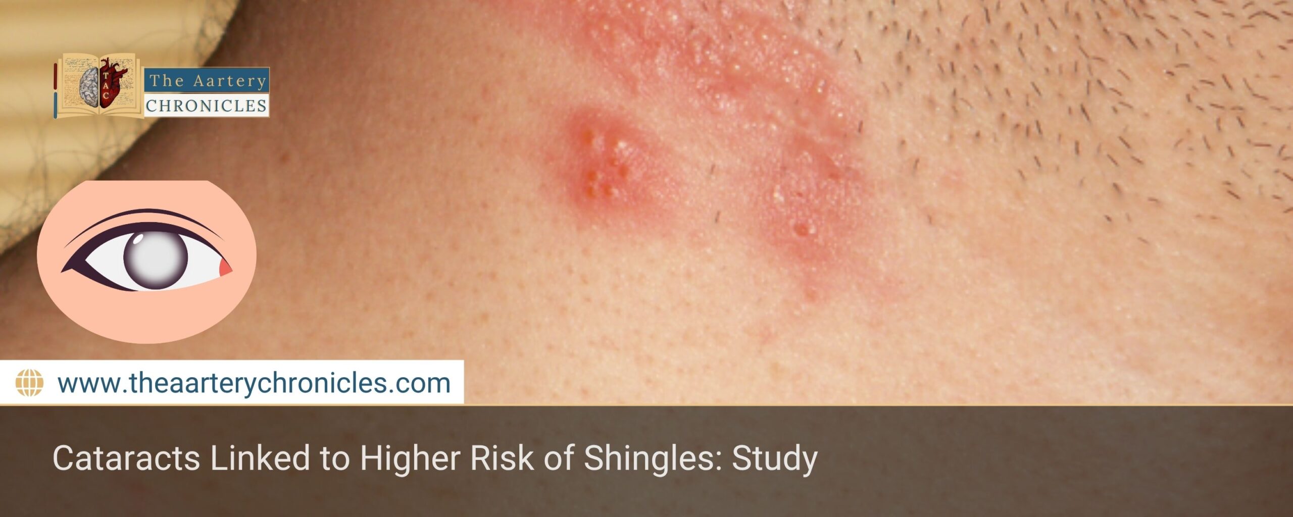 cataracts-and-shingles-a-surprising-link-you-shouldnt-ignore-the-aartery-chronicles-tac