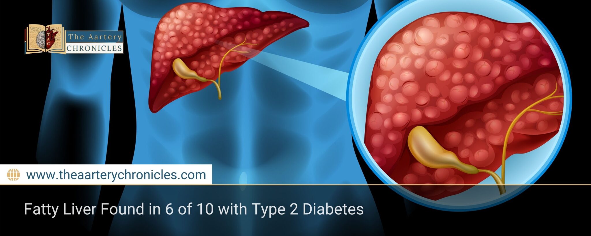 Fatty Liver Found in 6 of 10 with Type 2 Diabetes