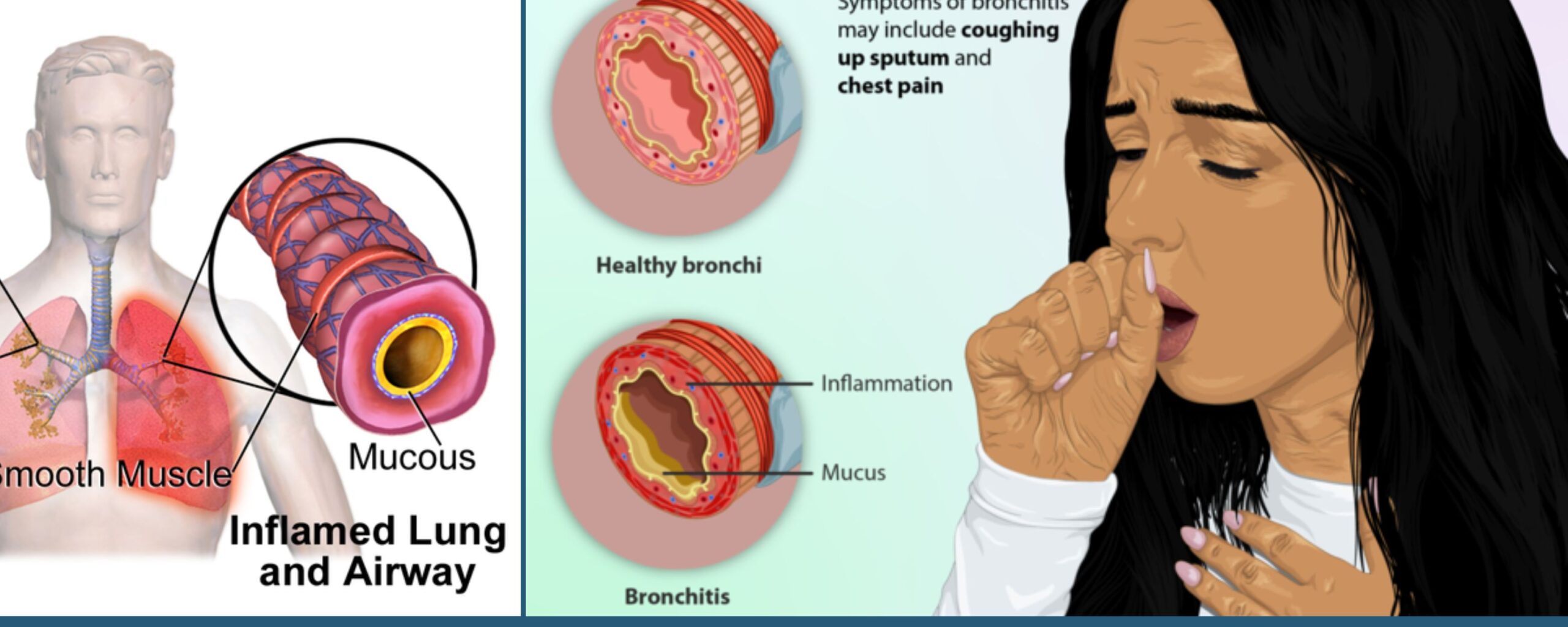 bronchitis-all-you-need-to-know-about-it-the-aartery-chronicles-tac