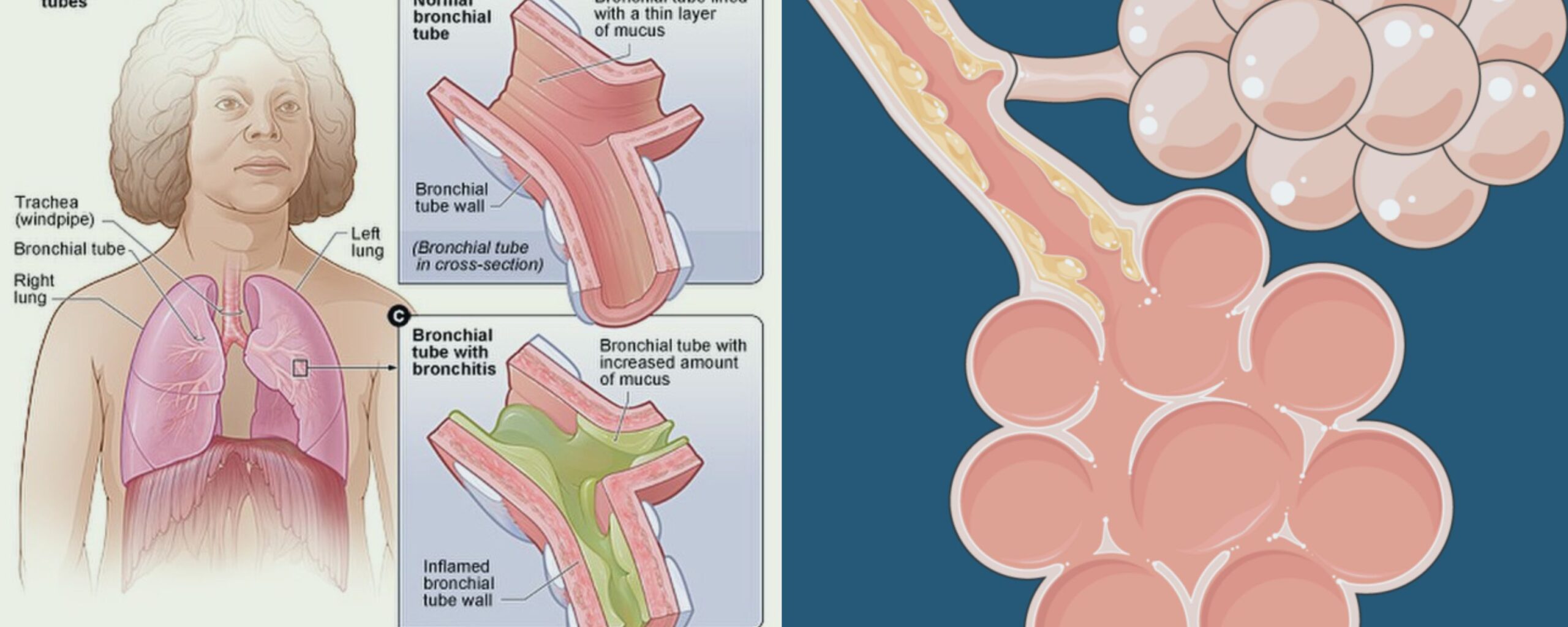 bronchitis-all-you-need-to-know-about-it-the-aartery-chronicles-tac