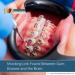 Shocking Link Found Between Gum Disease and the Brain