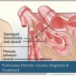 pulmonary-fibrosis-all-that-you-need-to-know-the-aartery-chronicles-tac