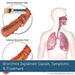 bronchitis-all-you-need-to-know-about-it-the-aartery-chronicles-tac