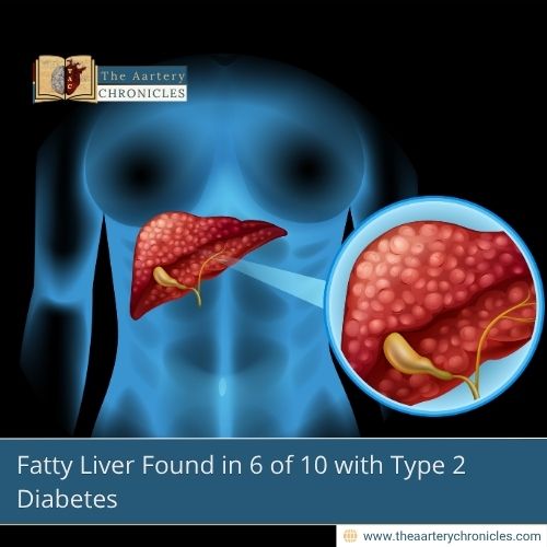 Fatty Liver Found in 6 of 10 with Type 2 Diabetes