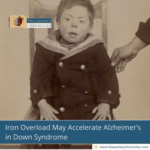 Why Does Alzheimer’s Strike So Early in Down Syndrome?