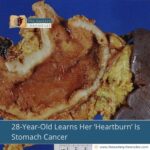 28-Year-Old Learns Her ‘Heartburn’ Is Stomach Cancer