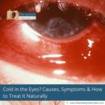 Cold-in-the-Eyes?-Causes,-Symptoms-&-How-to-Treat-It-Naturally-The-Aartery-Chronicles-TAC