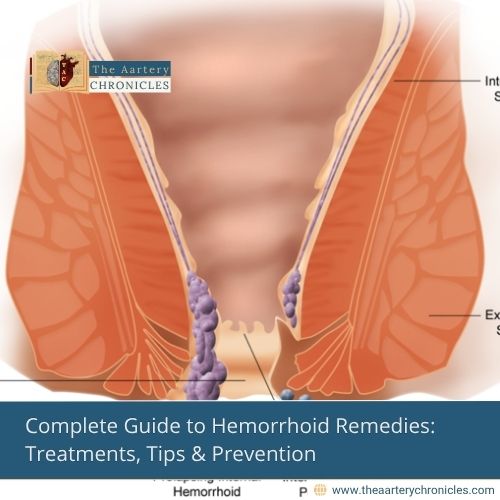 Complete-Guide-to-Hemorrhoid-Remedies:-Treatments,-Tips-&-Prevention-The-Aartery-Chronicles-TAC
